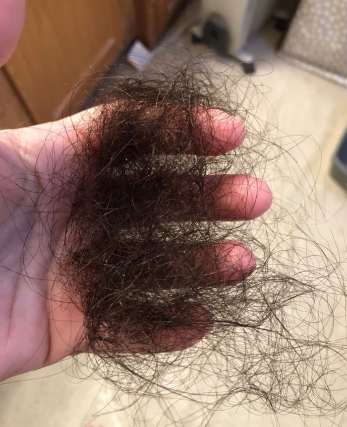 Your hair continues to thin, even after trying every treatment available.